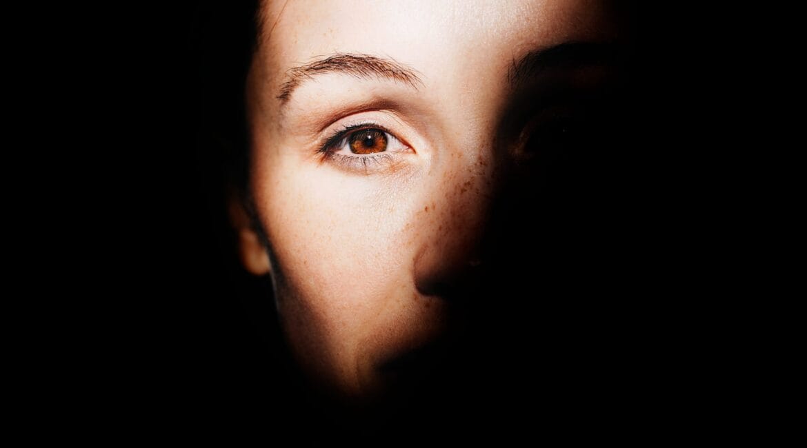 rosacea