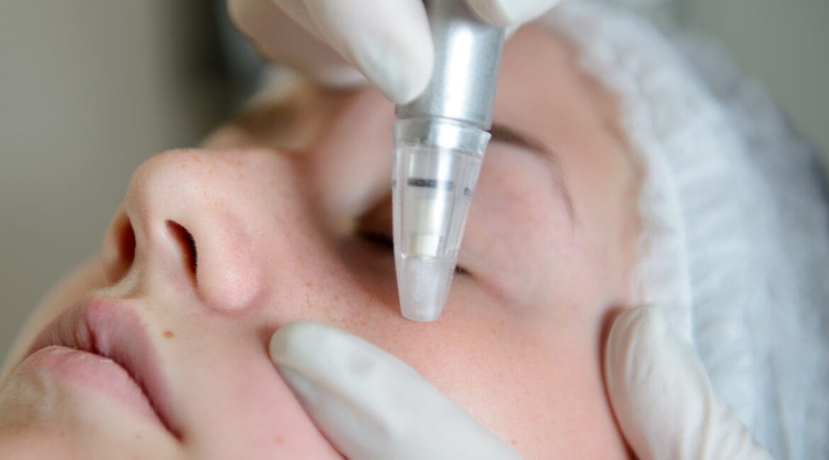 Microdermabrasie Rotterdam
