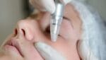 Microdermabrasie Rotterdam