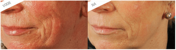 Enterpen-behandeling-microneedling