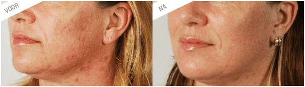 Enterpen-behandeling-microneedling