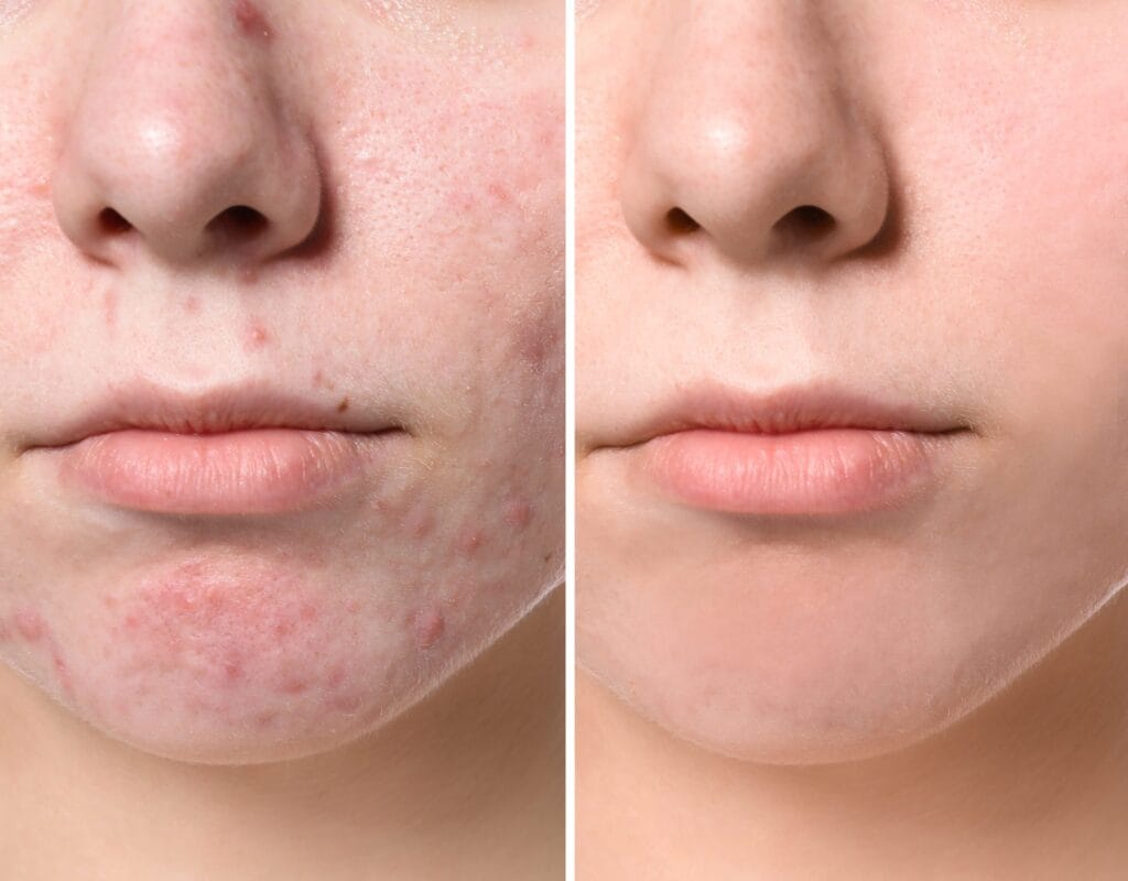 Acne behandeling Rotterdam