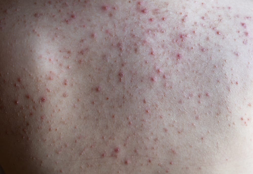 Acne rug