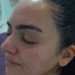 Acne behandeling Rotterdam