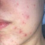 Oorzaak Acne