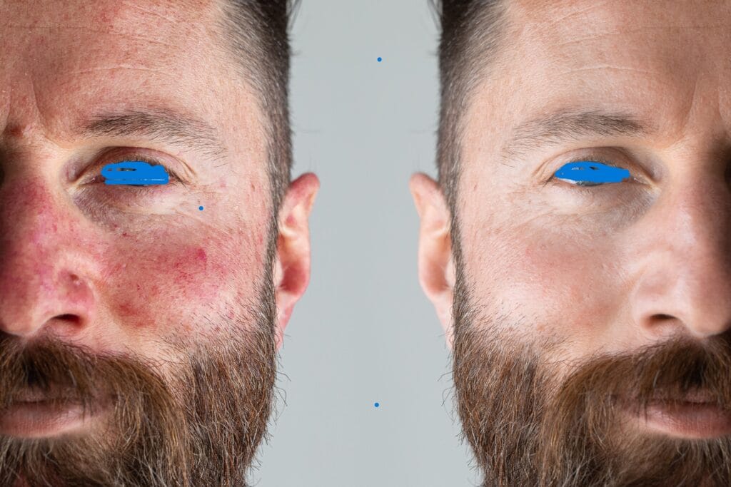 couperose laserbehandeling voor na foto