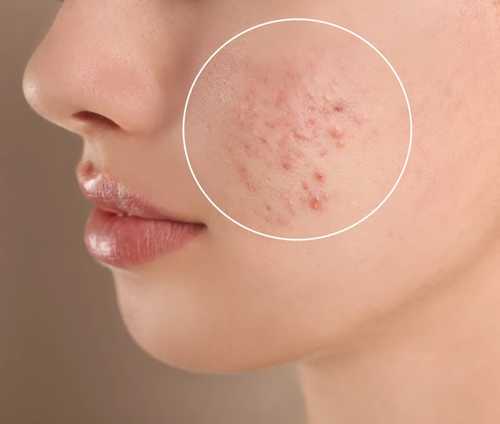 Acne behandeling rotterdam