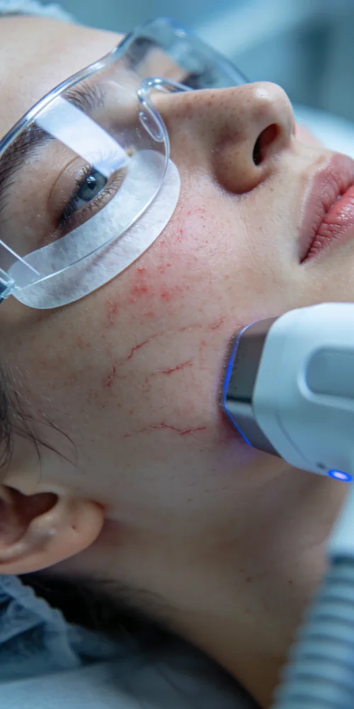 Laserbehandeling voor rosacea en zichtbare bloedvaatjes